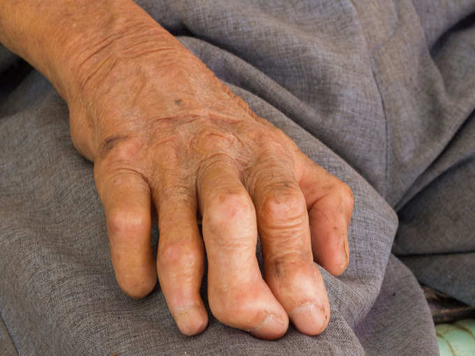 कल से घर-घर खोजे जाएंगे कुष्ठ रोगी : डा. अमित विक्रम