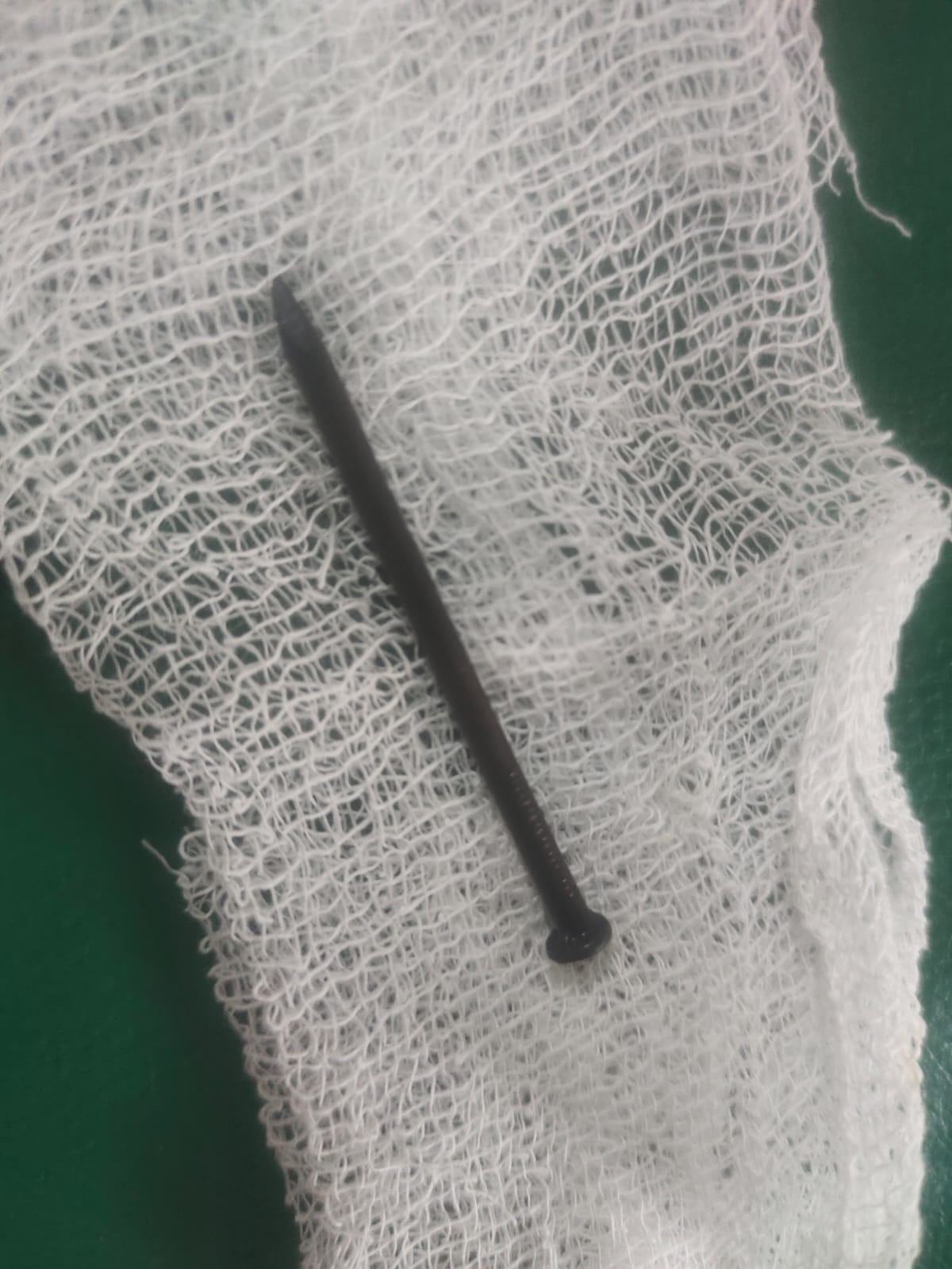 कांटी निगलने वाले बच्चे को डॉ. ने दिया नया जीवन